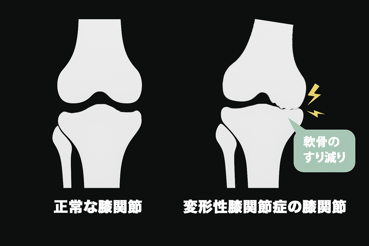 正常な膝と変形性膝関節症の比較イラスト