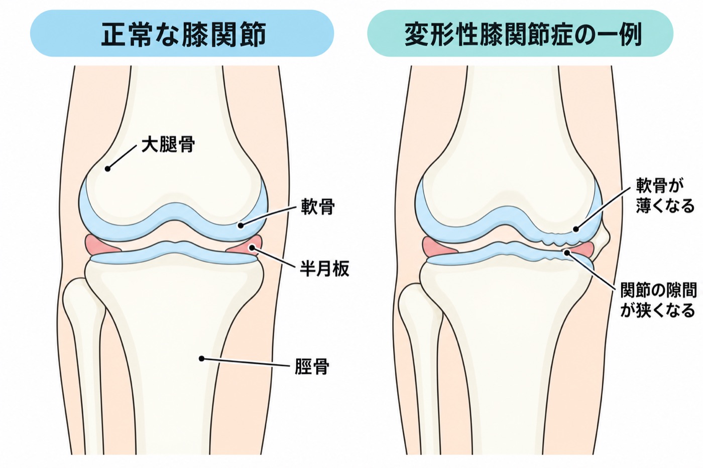 軟骨が保たれた膝。骨の関節面を軟骨が覆っている。