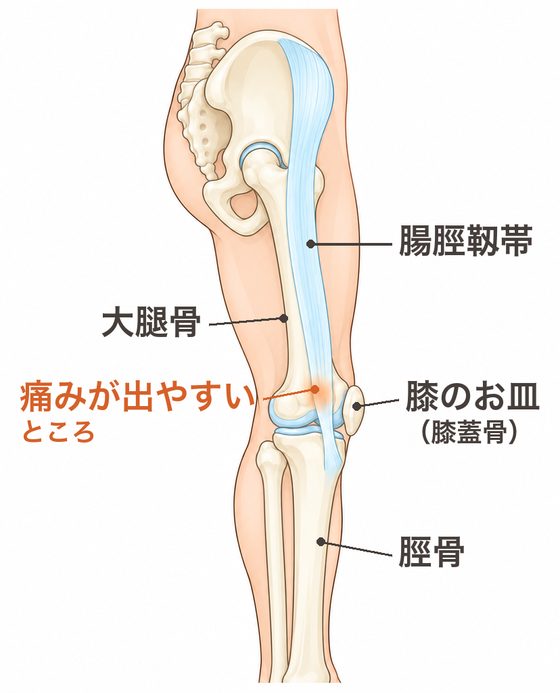 右脚を外側から見た解剖図。太ももの外側を腸脛靱帯が通り、膝の外側の骨の出っぱりの上が色づいている