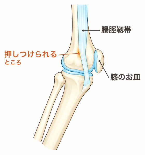 膝が少し曲がったときの膝の外側。腸脛靱帯が骨の出っぱりに押しつけられ、色づいている